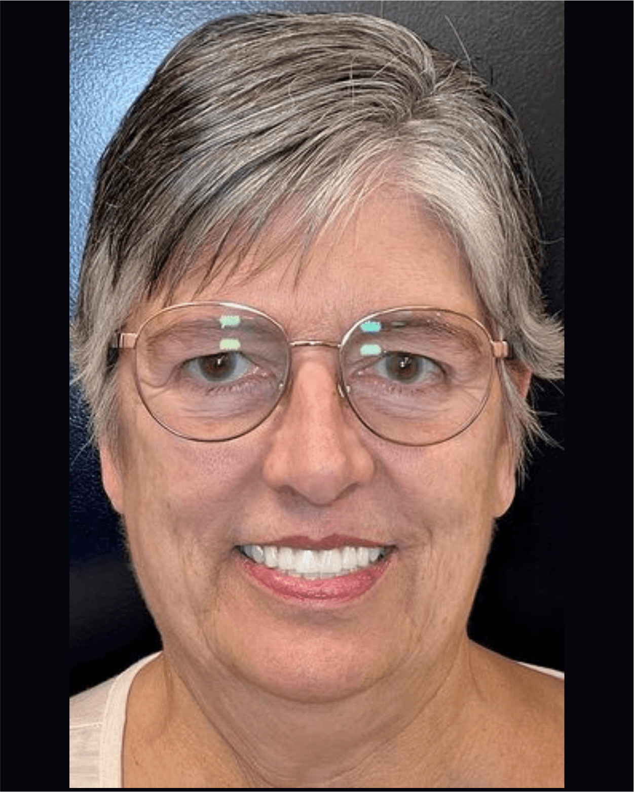 Dentista Cacoal Implantes dentarios